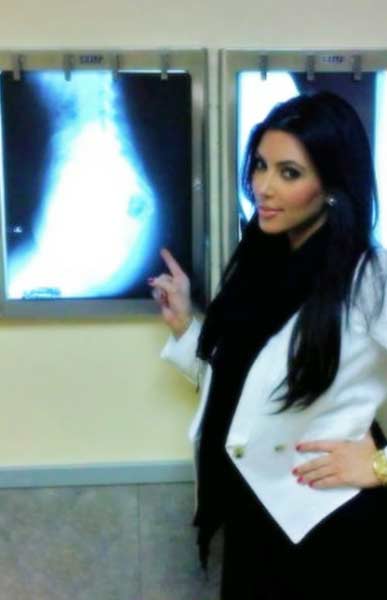 Kim Kardashian x-ray her buttocks